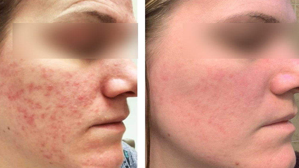 acido_mandelico_acne