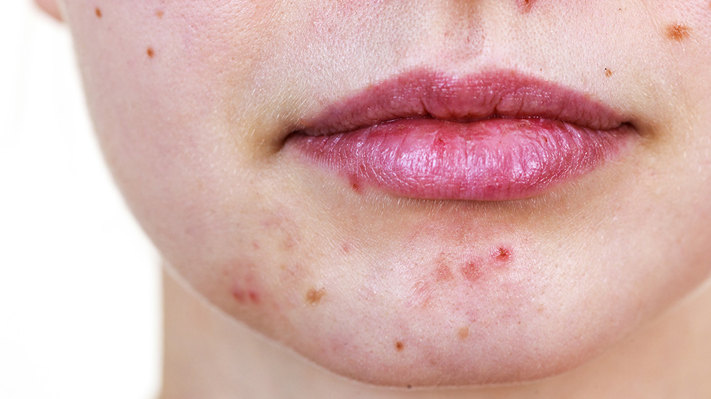 acne acido mandelico