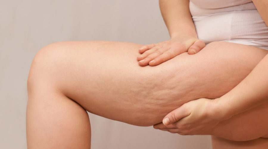 cellulite_edematosa