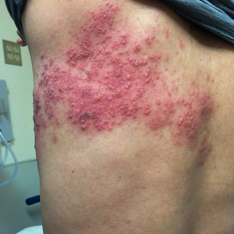 herpes_zoster