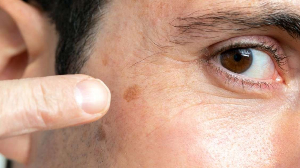 macchie scure acido mandelico