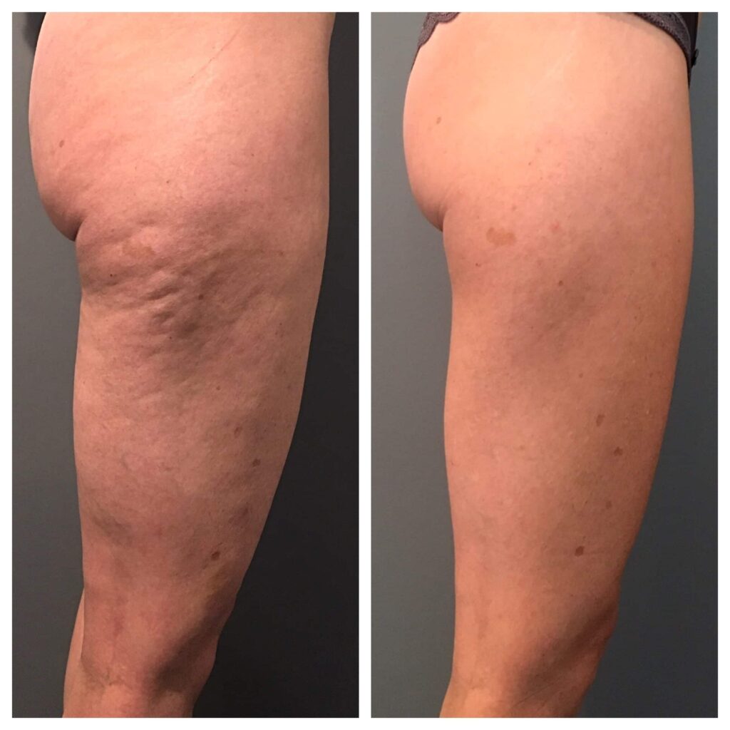 radiofrequenza cellulite