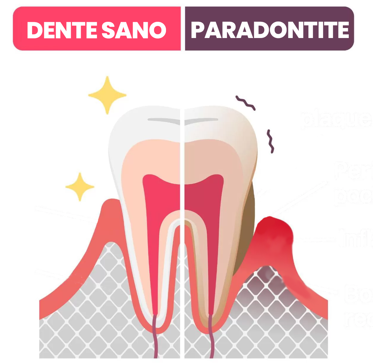 paradontite