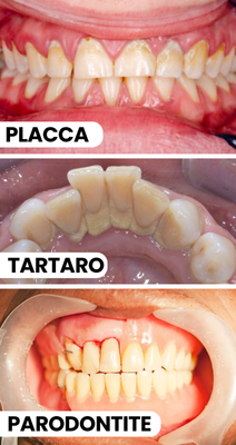 placca tartaro parodontite piorrea