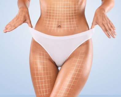 cellulite roma est