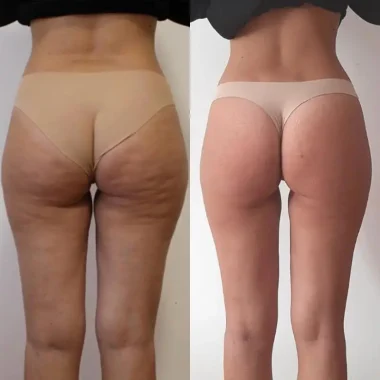 ENDOSPHERES therapy ROMA